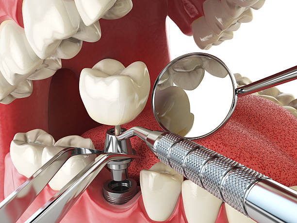 Best Emergency Root Canal Treatment in Belle Haven, VA